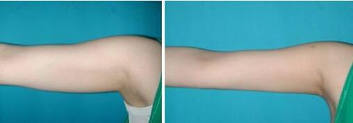 東莞動態(tài)細紋填充脂肪收費標準大約是多少(東莞星妃醫(yī)療美容門診部動態(tài)細紋填充脂肪參考價：6282元)