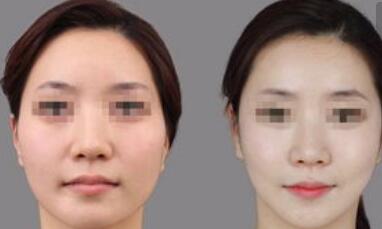 江西3D顴骨縮小的費(fèi)用查詢(江西東湖博美醫(yī)療美容門診部3D顴骨縮小參考價(jià)：5547元)