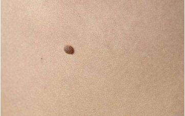 烏魯木齊大腿溶脂手術(shù)手術(shù)費用預(yù)覽(烏魯木齊人民醫(yī)院皮膚性病激光美容中心大腿溶脂手術(shù)參考價：3804元)