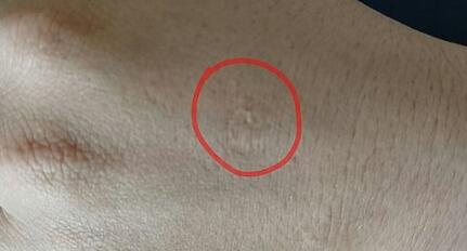 福州肉毒素除抬頭紋價(jià)格