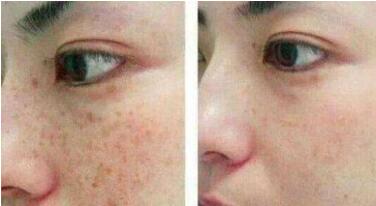 馬鞍山細(xì)胞激活法令紋價格