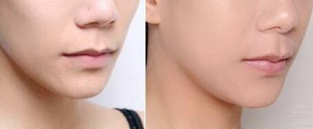 無錫假體隆鼻修復(fù)術(shù)一次應(yīng)該要多少錢(無錫時光醫(yī)療美容門診假體隆鼻修復(fù)術(shù)參考價：5707元)