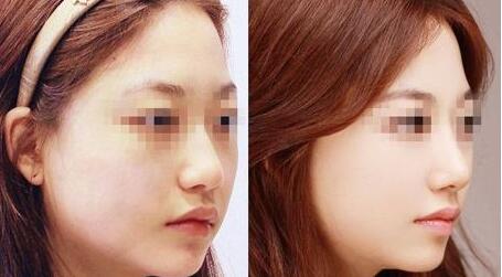 宿遷愛貝芙面部除皺價位表預覽(宿遷美萊雅醫(yī)療美容門診愛貝芙面部除皺參考價：5259元)