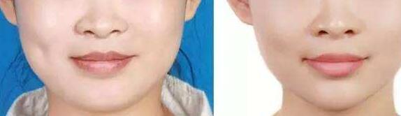 鄭州隱耳矯正術(shù)的報價大概需要多少價格(鄭州省人民醫(yī)院隱耳矯正術(shù)參考價：4011元)