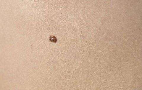 長(zhǎng)沙去粉刺價(jià)格