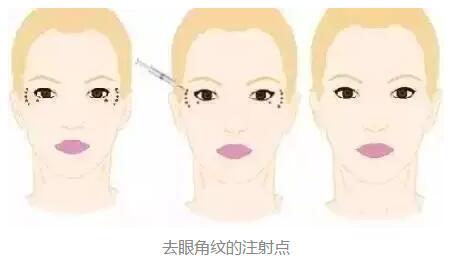 上海多重雙側(cè)乳頭整形收費(fèi)價(jià)目表公布(2023上海多重雙側(cè)乳頭整形參考價(jià)為：5817元)