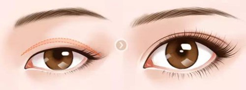 金華面部皺紋激光修復(fù)價格表(收費(fèi)標(biāo)準(zhǔn))(2023金華面部皺紋激光修復(fù)參考價為：5305元)