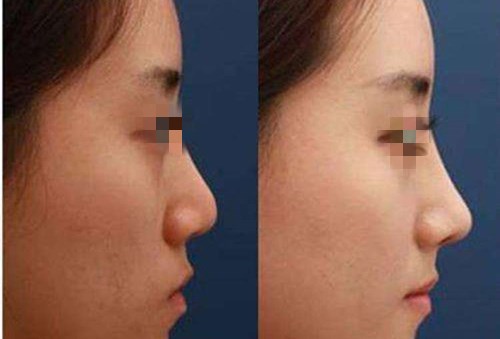 北京OS醫(yī)學分層祛斑手術價格查看(2023北京OS醫(yī)學分層祛斑參考價為：4809元)