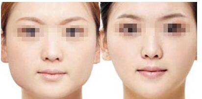 長沙開合鼻修復(fù)手術(shù)多少錢(2023長沙開合鼻修復(fù)參考價為：6512元)