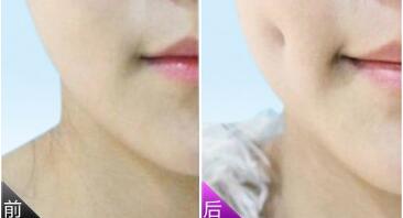 長(zhǎng)沙單眼皮紋眼線應(yīng)該需要花多少錢(2023長(zhǎng)沙單眼皮紋眼線參考價(jià)為：7091元)