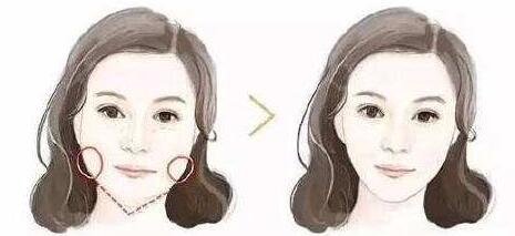 西安電子抽脂收費(fèi)標(biāo)準(zhǔn)2023查看(2023西安電子抽脂參考價(jià)為：7735元)