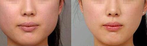 烏魯木齊去除眼底細(xì)紋皺紋價(jià)目表出爐(2023烏魯木齊去除眼底細(xì)紋皺紋參考價(jià)為：5857元)