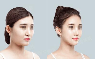 廣州射頻微針祛眼底紋一般需要花費(fèi)多少錢(2023廣州射頻微針祛眼底紋參考價(jià)為：6701元)