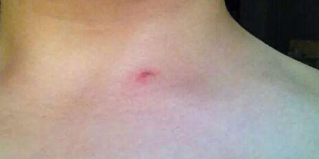 杭州祛法令紋針價(jià)格