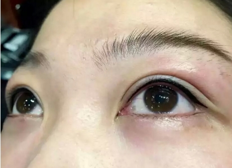 合肥射頻祛除眼紋優(yōu)惠價(jià)格一覽(2023合肥射頻祛除眼紋參考價(jià)為：5142元)