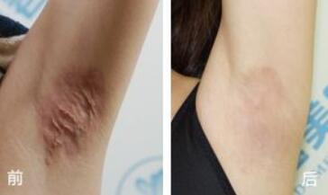 杭州射頻溶脂祛眼袋價(jià)格2023明細(xì)上線(2023杭州射頻溶脂祛眼袋參考價(jià)為：6389元)