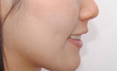 青島熊貓針去印第安紋整形價(jià)格預(yù)先一覽(2023青島熊貓針去印第安紋參考價(jià)為：7994元)