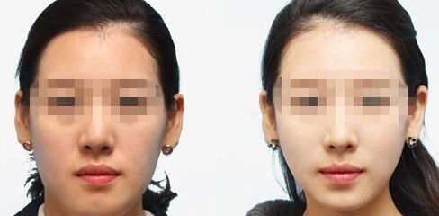 九江點(diǎn)陣激光祛眼底紋具體費(fèi)用一覽表(2023九江點(diǎn)陣激光祛眼底紋參考價(jià)為：6823元)