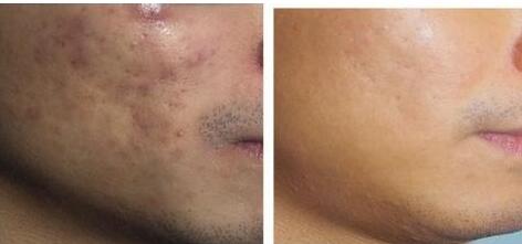 廈門曼托水滴隆胸術價格