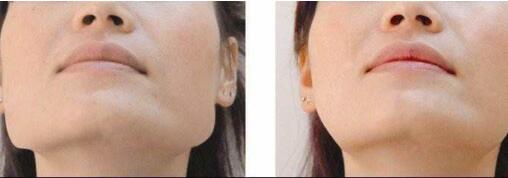 昆明電波拉皮瘦臉價(jià)格大概是多少啊(2023昆明電波拉皮瘦臉參考價(jià)為：6214元)