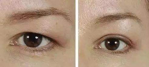 北京無針去眼周紋治療價格2023版(2023北京無針去眼周紋參考價為：6162元)