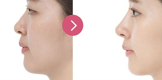 北京玻尿酸豐眼窩大致能花費(fèi)多少費(fèi)用(2023北京玻尿酸豐眼窩參考價(jià)為：6499元)