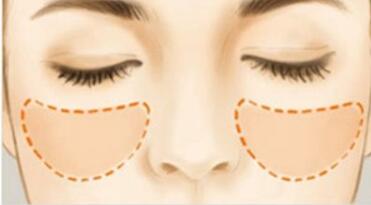 佛山眼周紋剝離術(shù)的價(jià)格清單(佛山順德中醫(yī)院整形科眼周紋剝離術(shù)參考價(jià)：5721元)