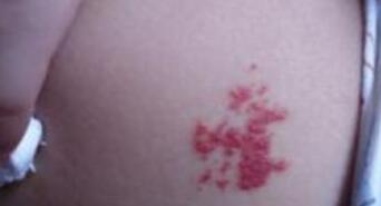 上海激光祛除黃褐斑一次手術(shù)費用是多少(2023上海激光祛除黃褐斑參考價為：7182元)