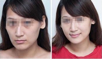 北京脂肪膠填充面部一般價(jià)格多少錢(2023北京脂肪膠填充面部參考價(jià)為：6524元)