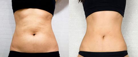 江蘇溶脂注射腰部要價(jià)格是多少費(fèi)用啊(2023江蘇溶脂注射腰部參考價(jià)為：6195元)