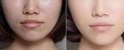 泰州曼特波隆下巴價(jià)位表明細(xì)一覽(泰州第一人民醫(yī)院整形科曼特波隆下巴參考價(jià)：4801元)