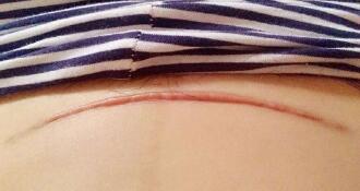 鄭州懸吊手術提升價格