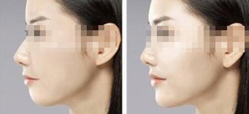 玉林激光治療紅血絲一般要多少錢(2023玉林激光治療紅血絲參考價為：6513元)