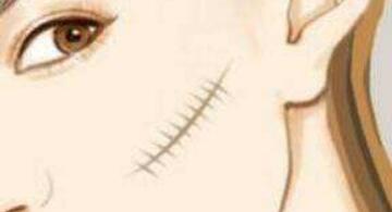 東莞膠原蛋白填充眼周紋費用表上線(2023東莞膠原蛋白填充眼周紋參考價為：5666元)