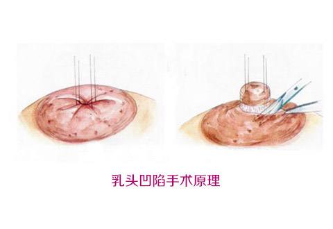 杭州微創(chuàng)手術(shù)去法令紋手術(shù)費用全新參考(2023杭州微創(chuàng)手術(shù)去法令紋參考價為：7132元)