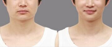 南寧玻尿酸鼻唇溝注射除皺手術(shù)費(fèi)剖析(2023南寧玻尿酸鼻唇溝注射除皺參考價(jià)為：5836元)