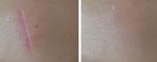 蕪湖靜態(tài)抬頭紋手術(shù)價(jià)格