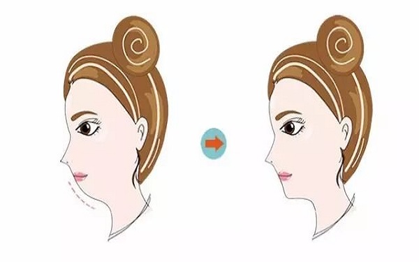 寧波臉部抽脂手術(shù)價格表2023版均價公布(寧波大學醫(yī)學院附屬醫(yī)院臉部抽脂手術(shù)參考價：4800元)