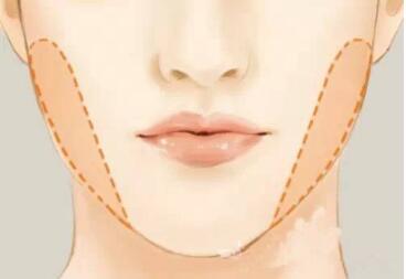 洛陽生物注射縮鼻頭治療價格出爐(2023洛陽生物注射縮鼻頭參考價為：6866元)