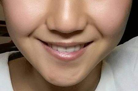 江門(mén)微創(chuàng)面部吸脂術(shù)的費(fèi)用多少錢(qián)查詢(xún)?nèi)缦?2023江門(mén)微創(chuàng)面部吸脂術(shù)參考價(jià)為：6131元)