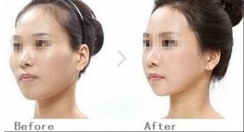 洛陽(yáng)微針治療痘印一次應(yīng)該需要多少錢(qián)(2023洛陽(yáng)微針治療痘印參考價(jià)為：5549元)