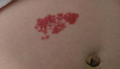 杭州冷凍去除太田痣價格