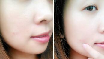 上海印第安紋除皺整形價(jià)格表在線公布(2023上海印第安紋除皺參考價(jià)為：6508元)