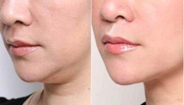 唐山注射填充川字紋的費用清單(2023唐山注射填充川字紋參考價為：6752元)