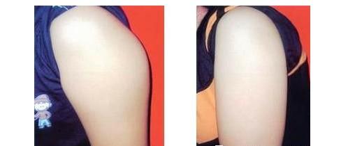 九江上頜骨內推手術價目表明細查詢(2023九江上頜骨內推手術參考價為：6425元)