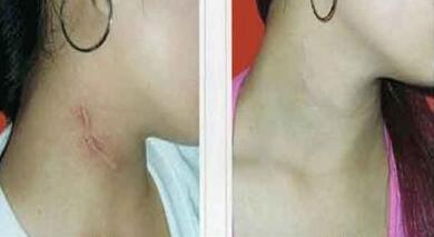 南京激光脫毛手術(shù)價(jià)格