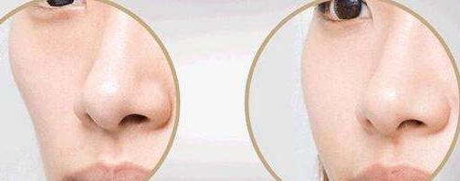 昆明微創(chuàng)線雕鼻報(bào)價(jià)價(jià)格是多少(2023昆明微創(chuàng)線雕鼻參考價(jià)為：6549元)