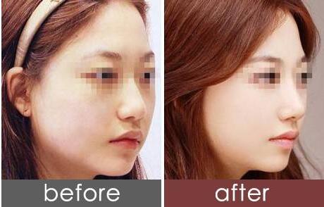 常州激光治療川字紋手術(shù)價(jià)格全面呈現(xiàn)(2023常州激光治療川字紋參考價(jià)為：6669元)