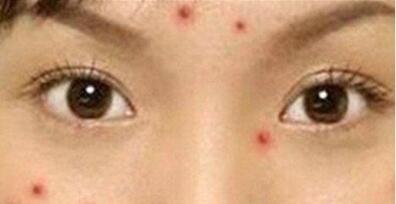 鄭州臉部除皺針整形科價格表預(yù)先一覽(2023鄭州臉部除皺針參考價為：6613元)