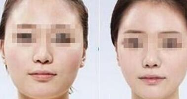 北京減下巴的手術費用大概要多少錢一次(2023北京減下巴參考價為：6232元)